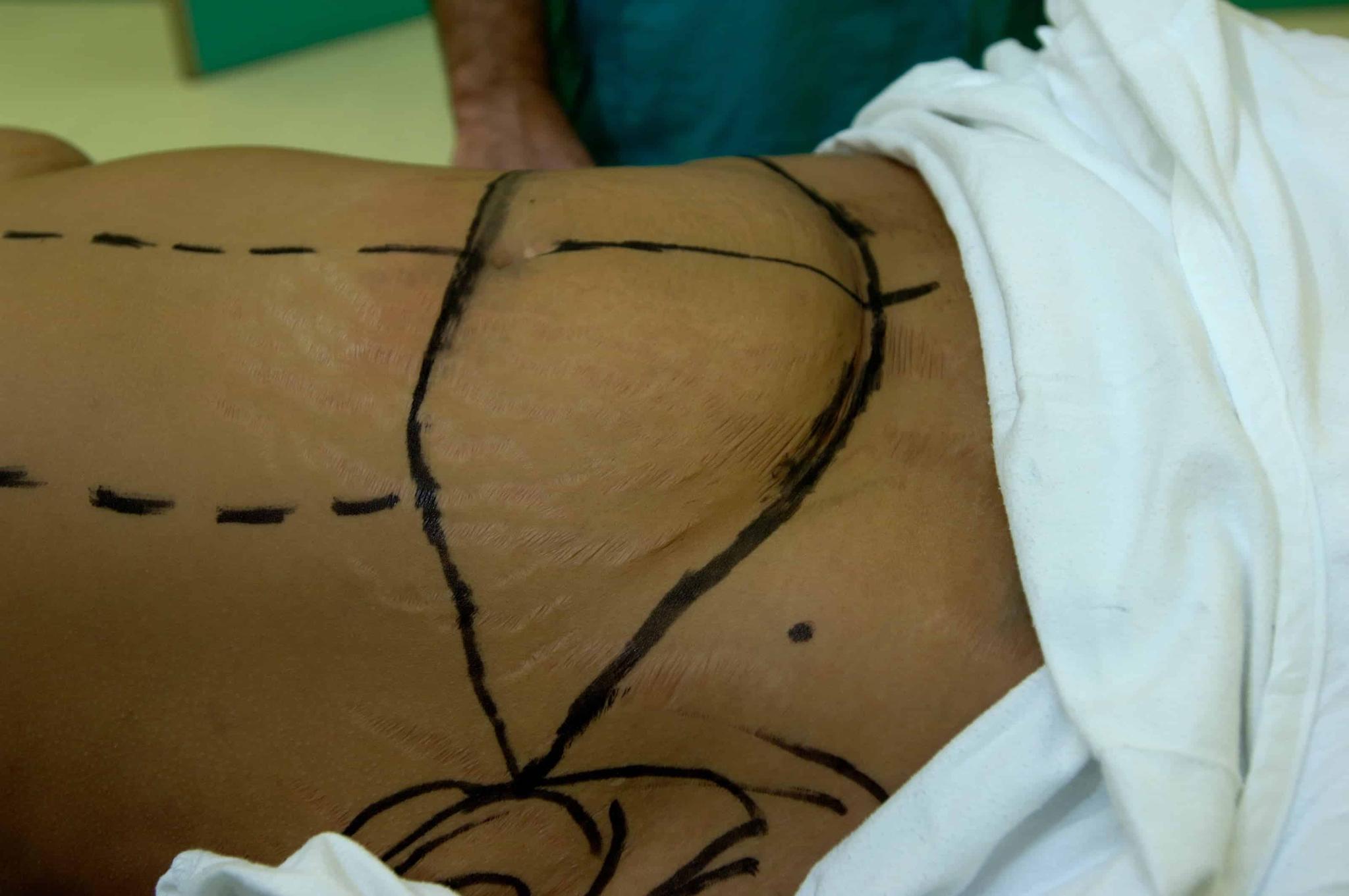 Mexican Nurse Dies After Performing Liposuction On Herself